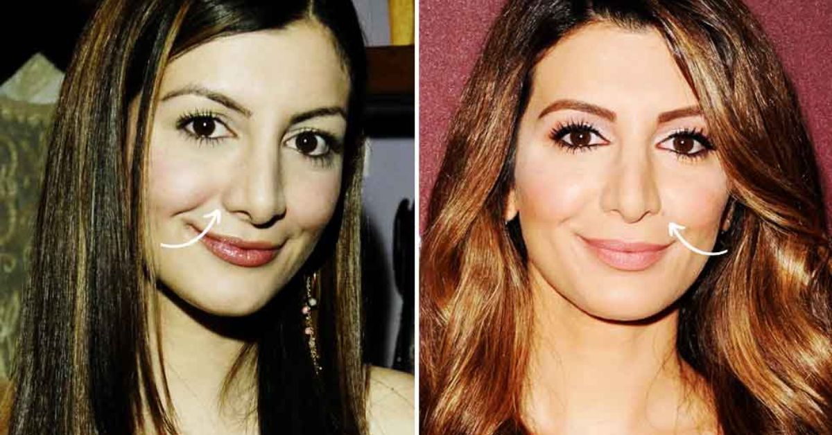 Nasim Pedrad Plastic Surgery