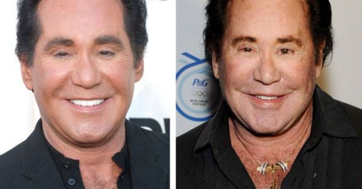 Wayne Newton Plastic Surgery